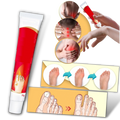 Crème anti-inflammatoire pour oignons du pied