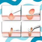 Pinces de précision pour points noirs