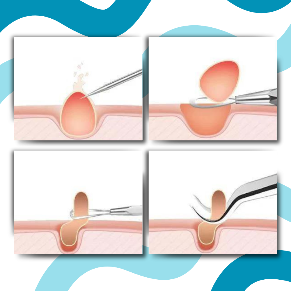 Pinces de précision pour points noirs