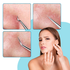 Pinces de précision pour points noirs