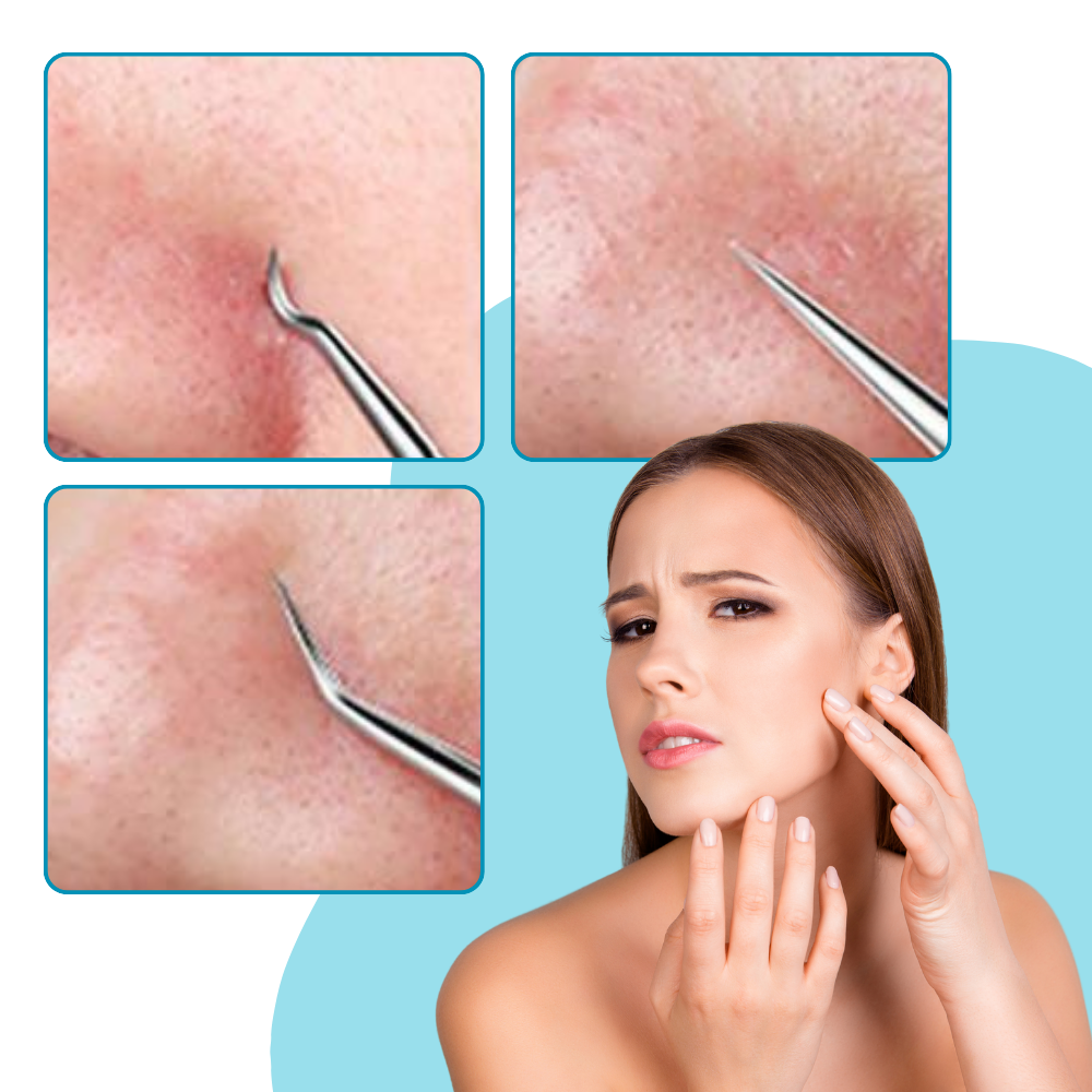 Pinces de précision pour points noirs